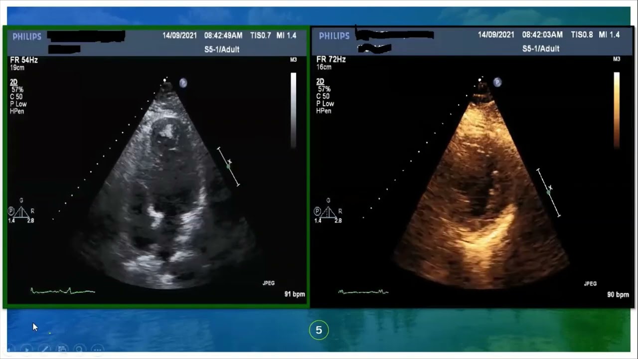 Echo cases (2), Dr Yasser Alashhab, 17/5/2022