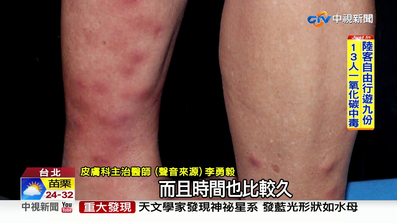 罕見!小腿長紅疹 竟罹死亡率九成的