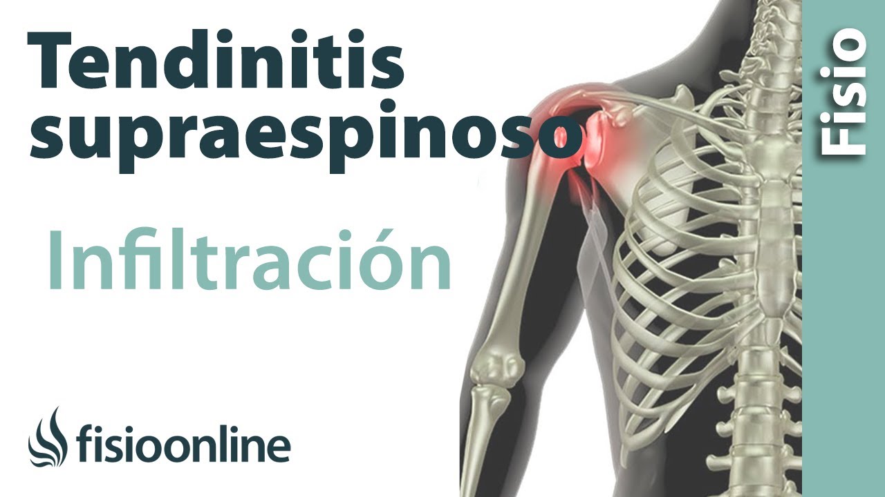 Tendinitis de hombro o supraespinoso infiltraciones