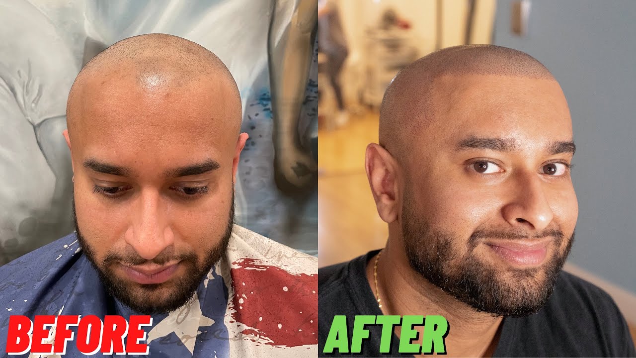 UNBELIEVABLE Scalp Micropigmentation Result in New York City