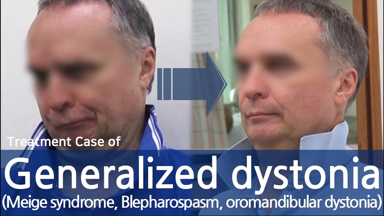 Generalized dystonia / Meige syndrome / Blepharospasm /oromandibular dystonia / 전신사경증 치료사례