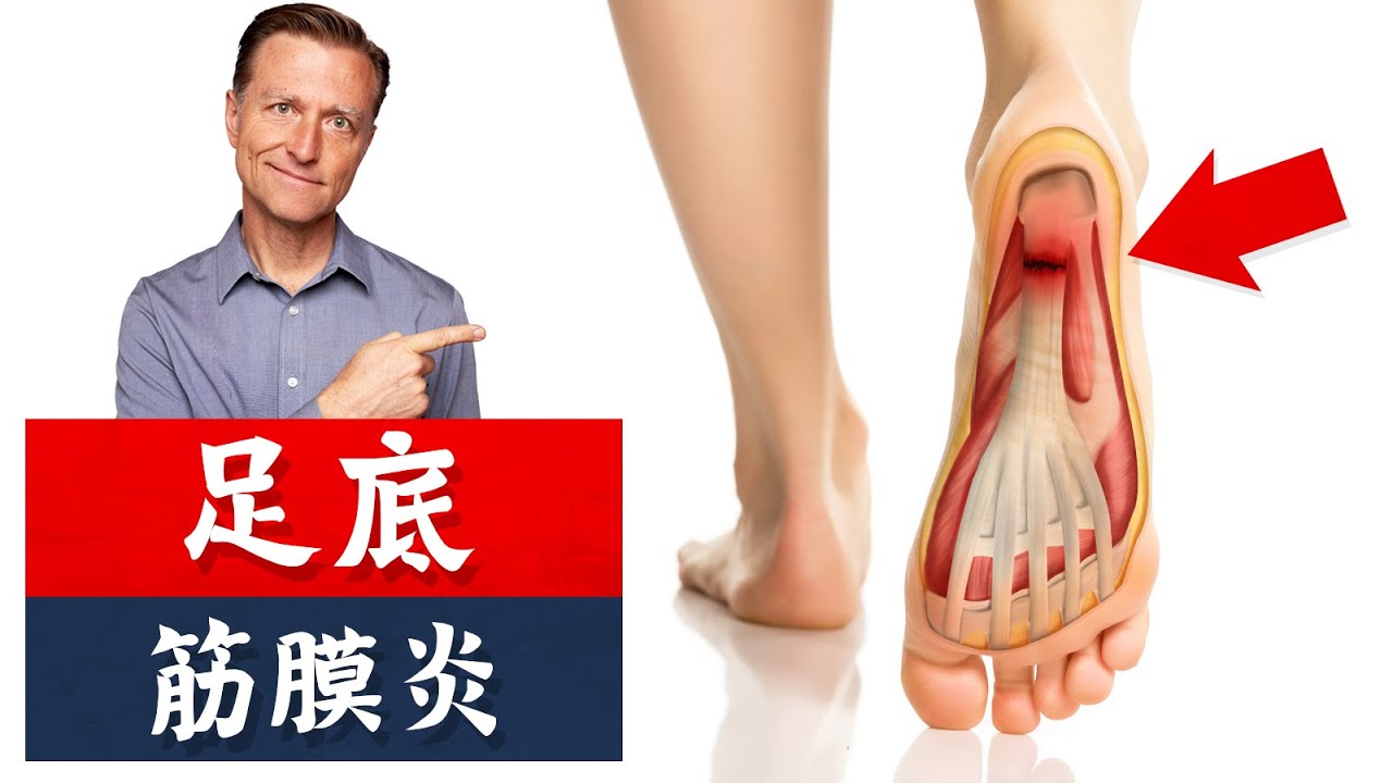 消除足底筋膜炎,運動與營養,,柏格醫生 Dr Berg