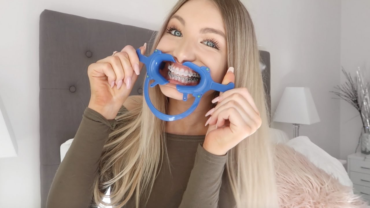 6 Month Braces Update | Gold wires???