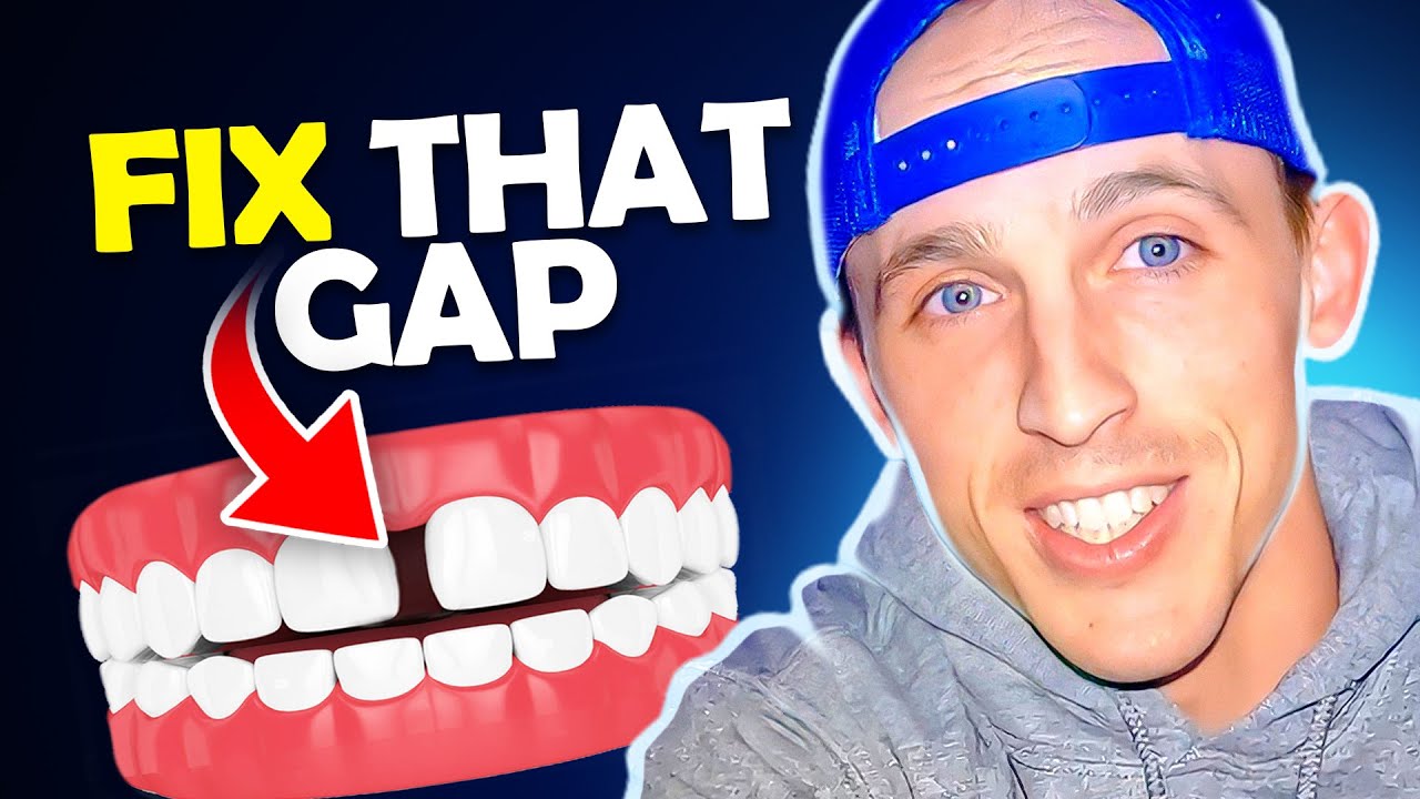 Diastema Closure with Orthodontics | McKinney Orthodontist Explains