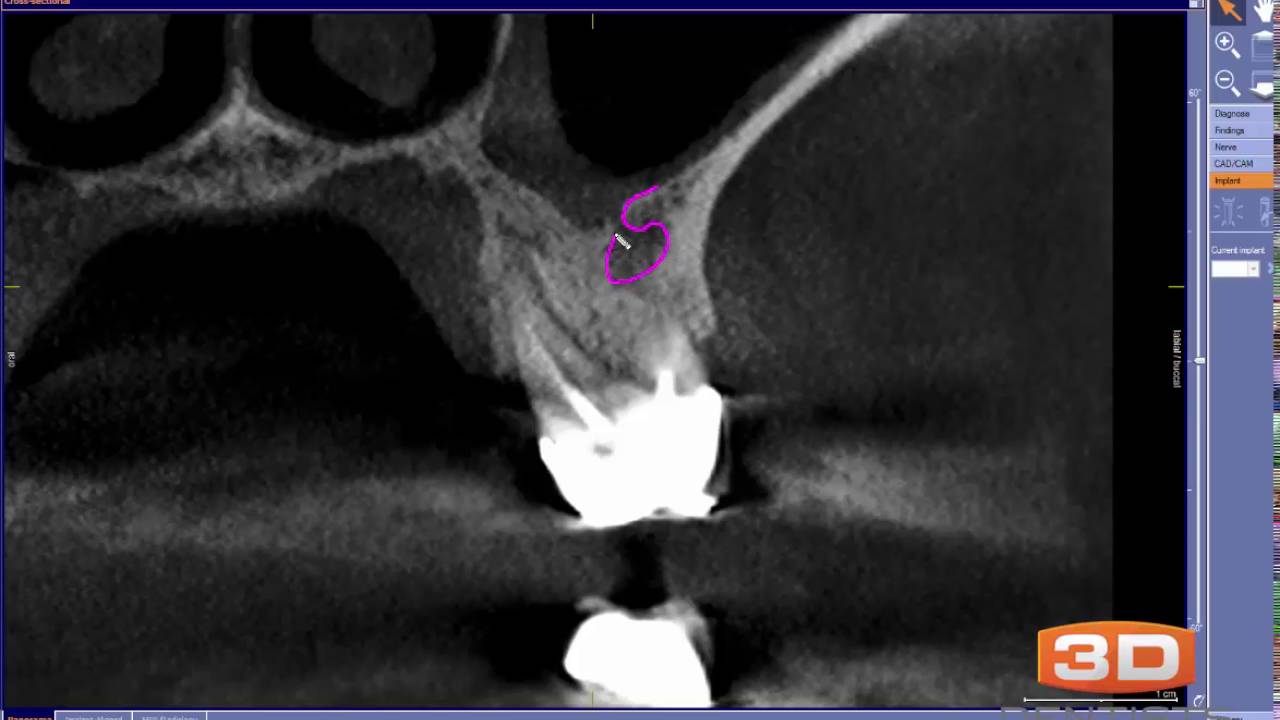 Using 3D CBCT to determine origin of sinus issue