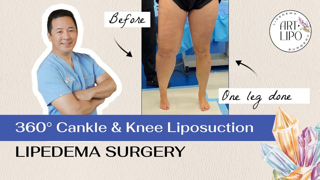 360&deg; Cankle & Knee Liposuction | Lipedema Surgery | Expert Dr. Thomas Su | Artlipo