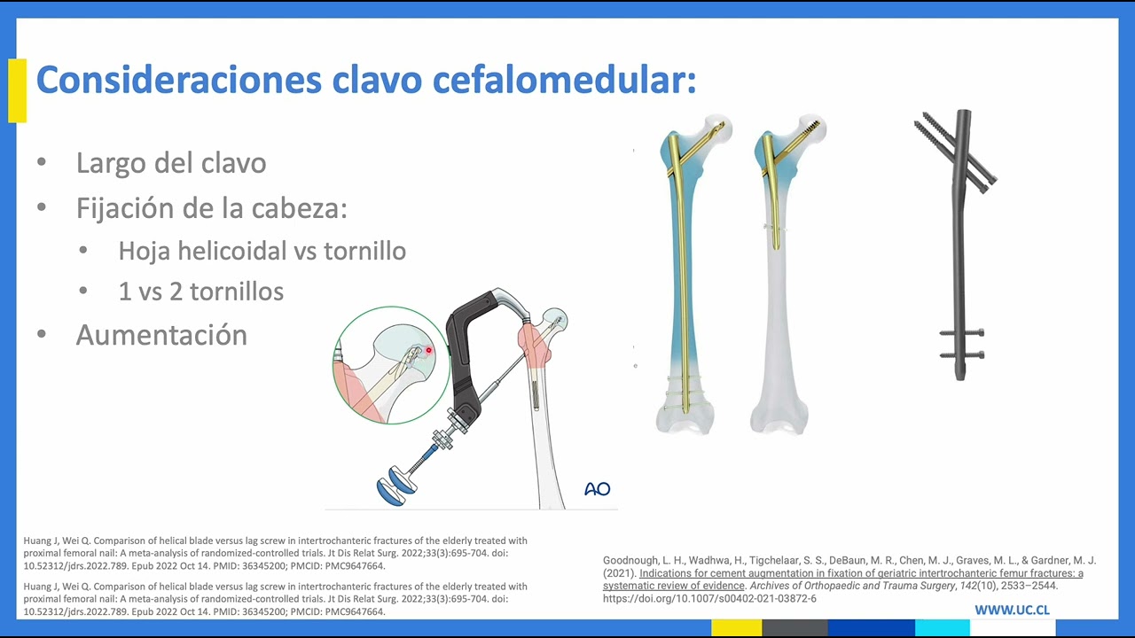 Fracturas de Cadera Pertrocantéricas y Subtrocantérica  Seminarios Ortopedia y Traumatología UC 2024