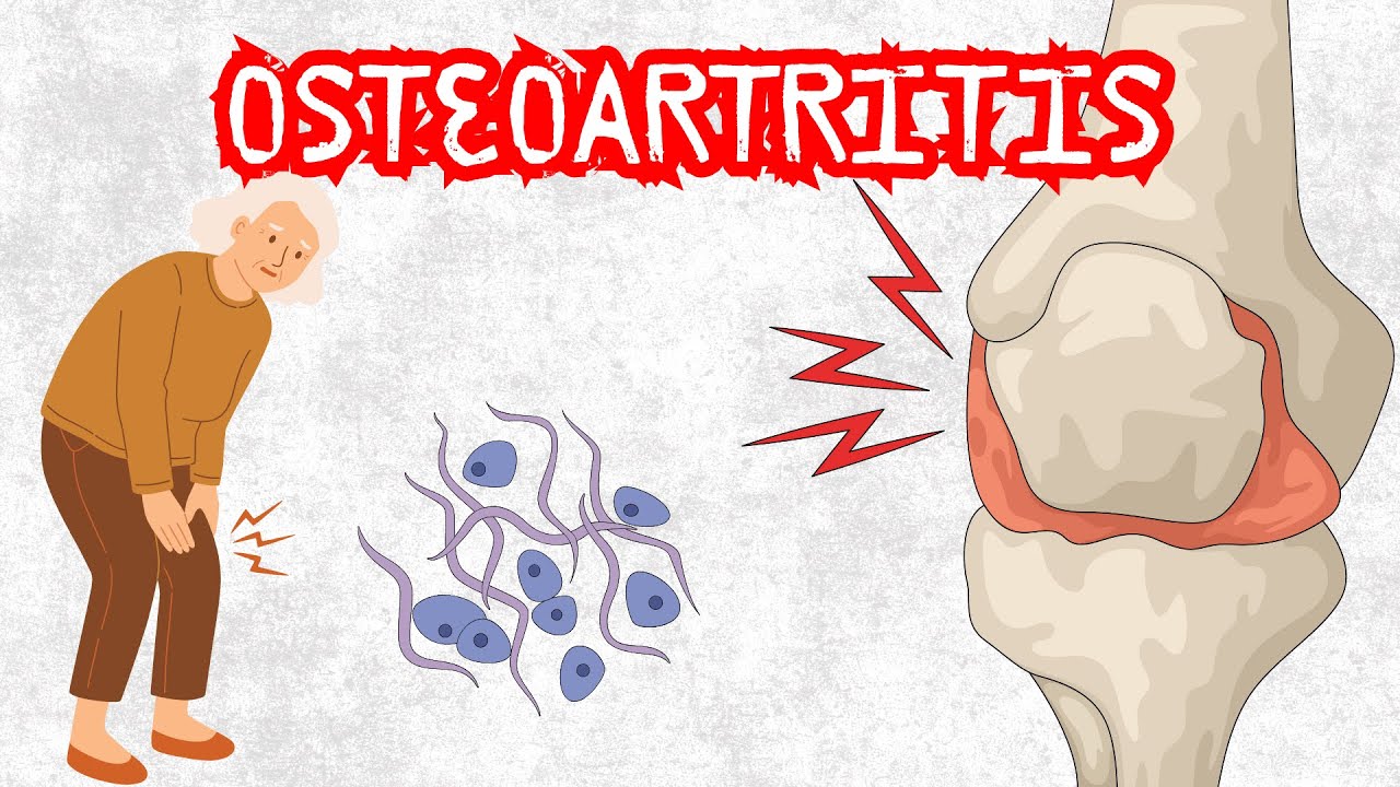 OSTEOARTITIS