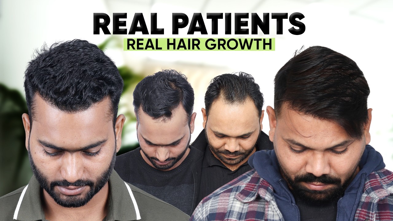 Hair Transplant in Mangaluru (HX-AGAT) | Best Results & Cost of Hair Transplant in Mangaluru.