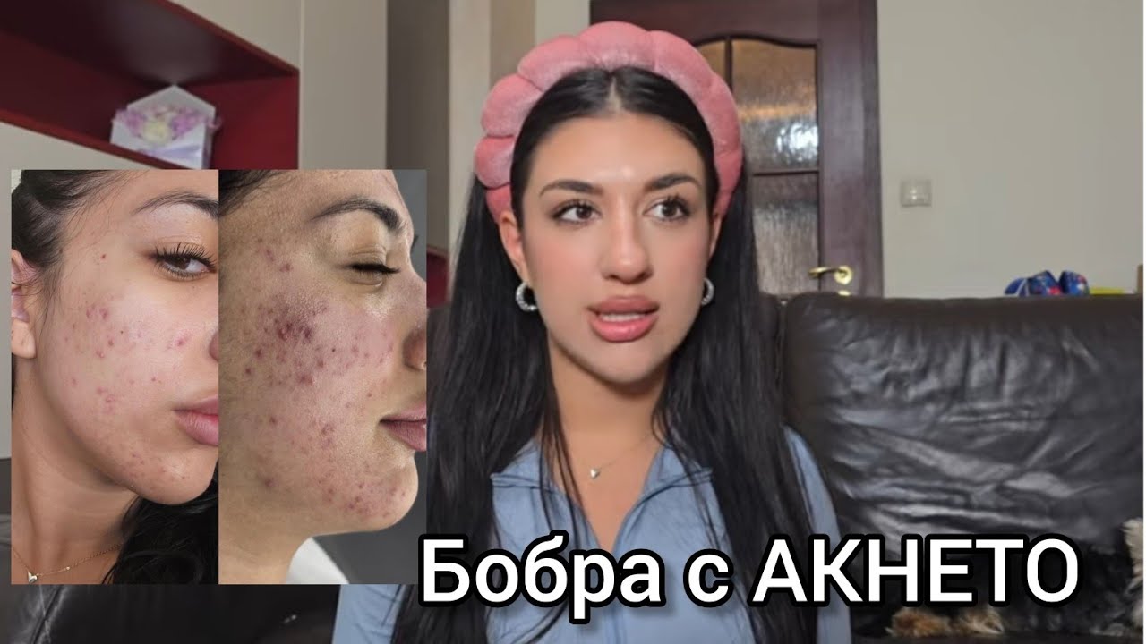 Моята Борба с Акнето