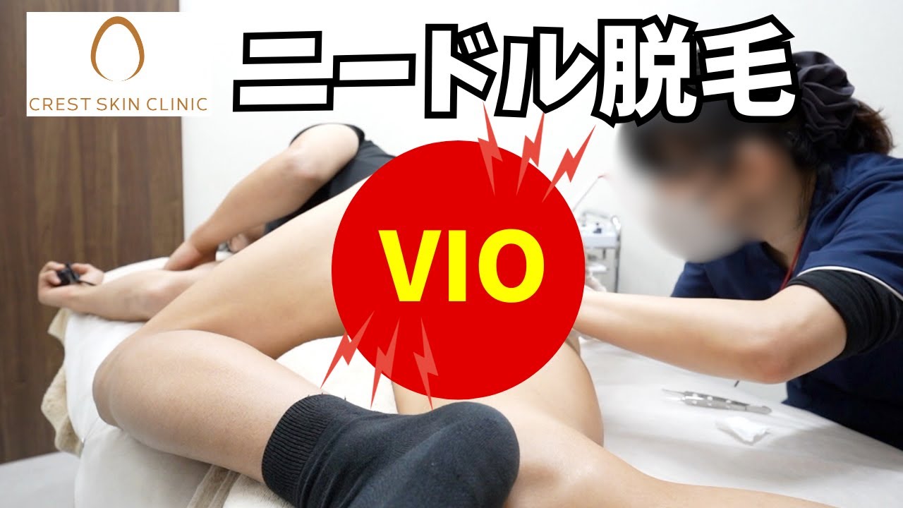 【初体験】VIOをニードル脱毛してみた結果がすごすぎた、、、【クレストスキンクリニック】