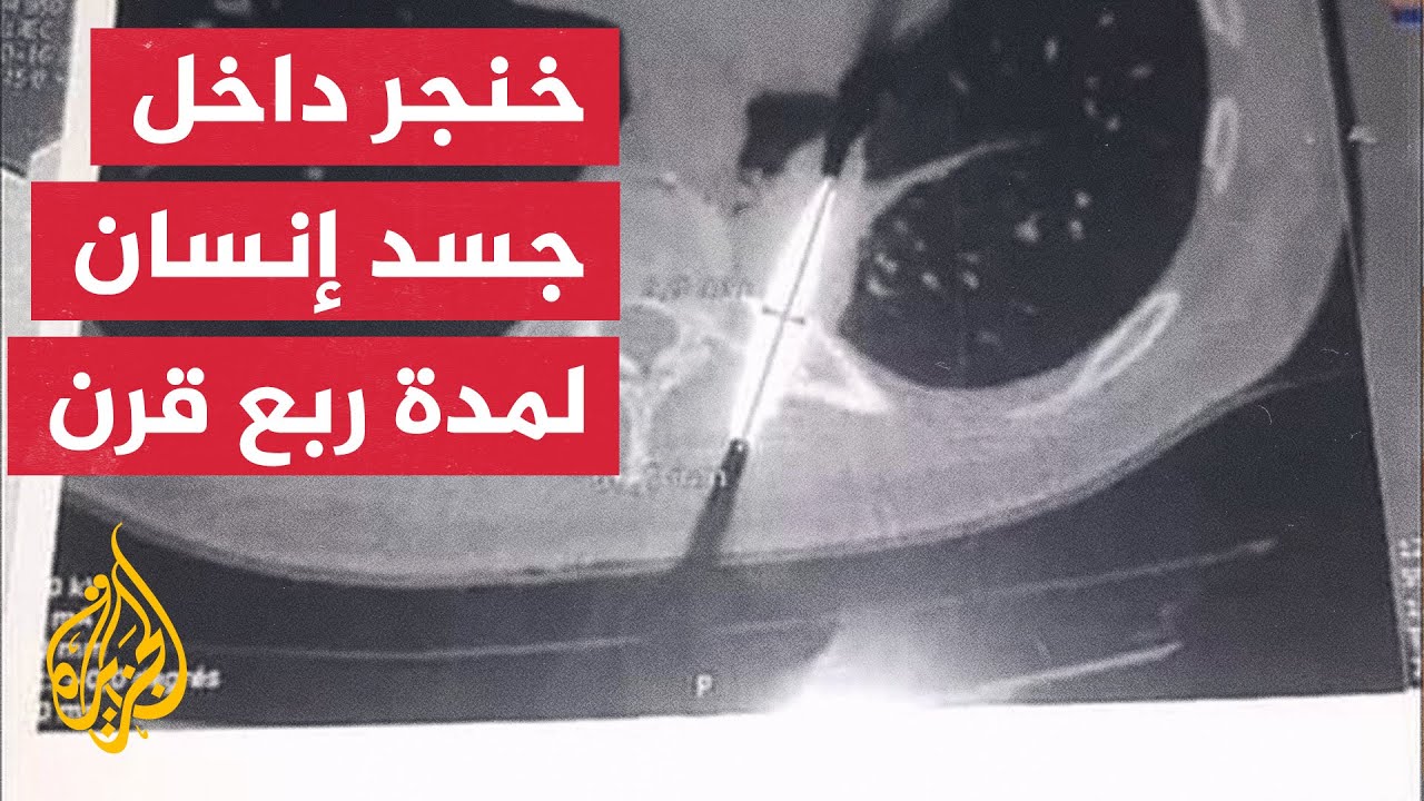 جراحون تونسيون يستأصلون خنجرا من ظهر جزائري لازمه ربع قرن