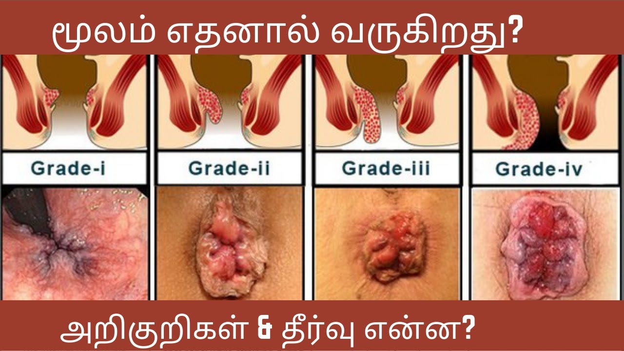 மூலம் என்றால் என்ன? யாருக்கு வரலாம்?அறிகுறிகள் என்ன?