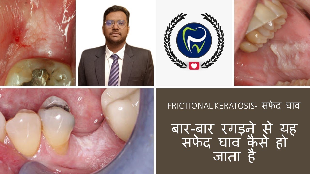Dr Rudra Mohan |मुंह में सफेद दाग |Frictional Keratosis| बार-बार रगड़ने से यह सफेद घाव कैसे हो जाता