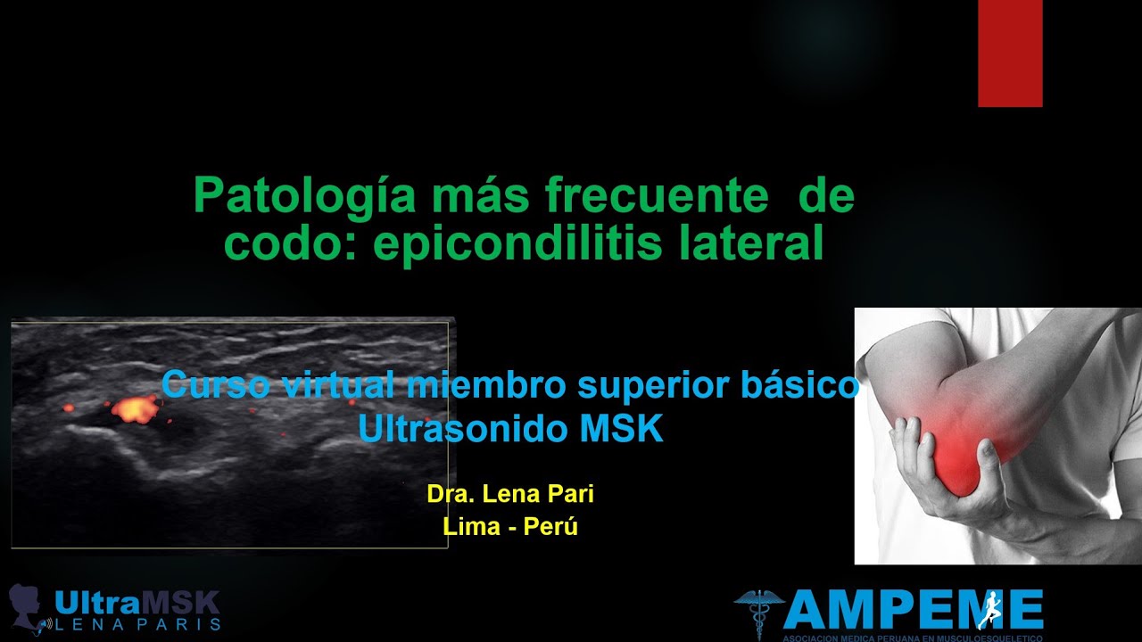 Epicondilitis lateral, como hago el diagnostico con ultrasonido ?