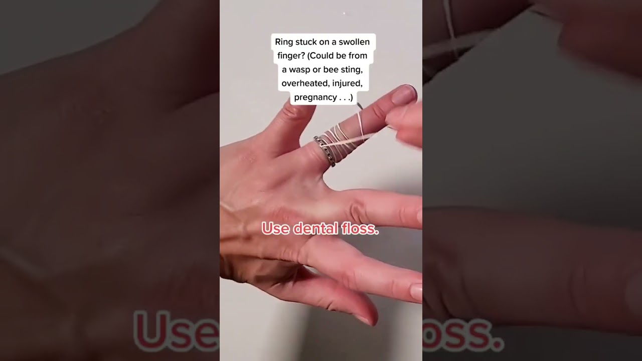 Remove a ring from a swollen finger 🦷🤞