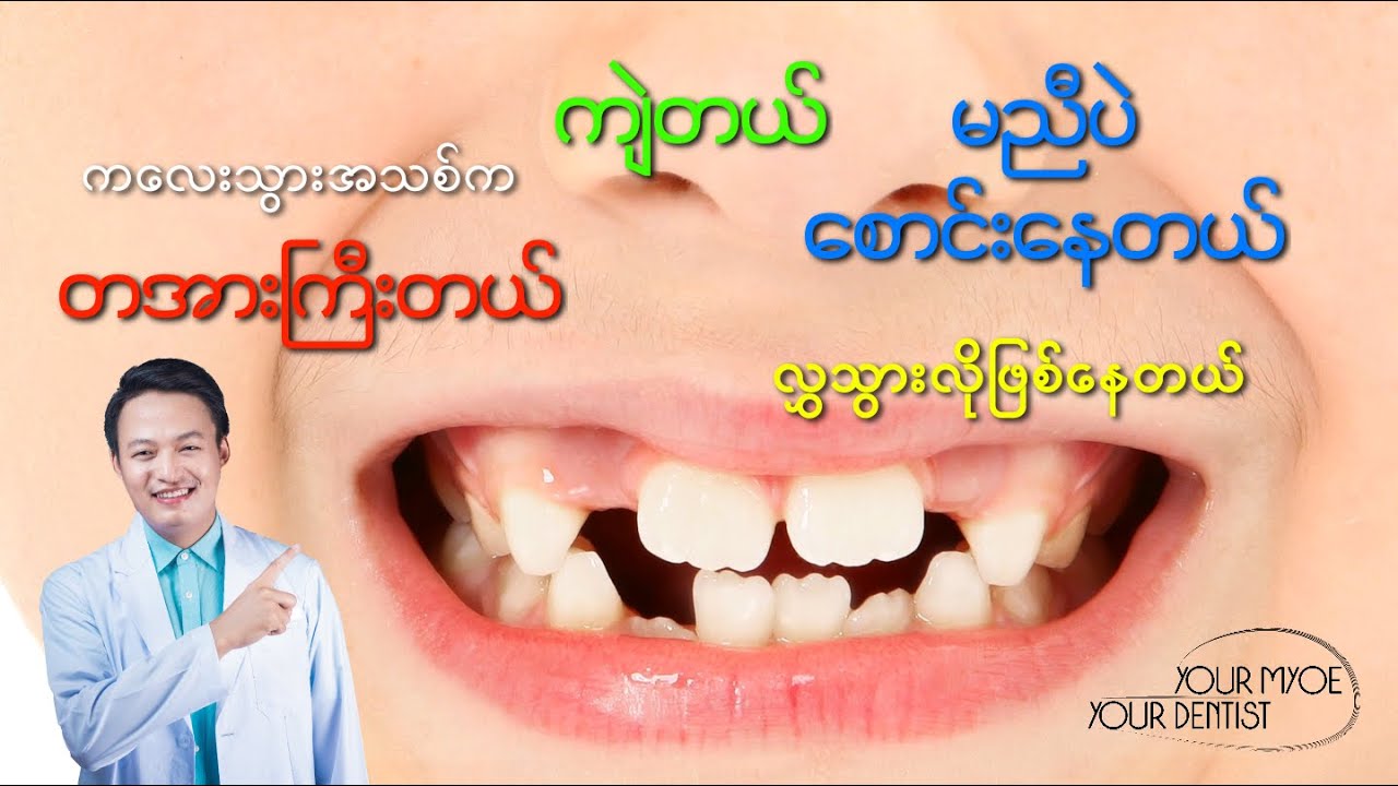 ကလေးသွားလဲပြီးပေါက်လာတဲ့ သွားအသစ်တွေက မလှဘူးဖြစ်နေတယ်။ ဘာလုပ်ရမလဲ?