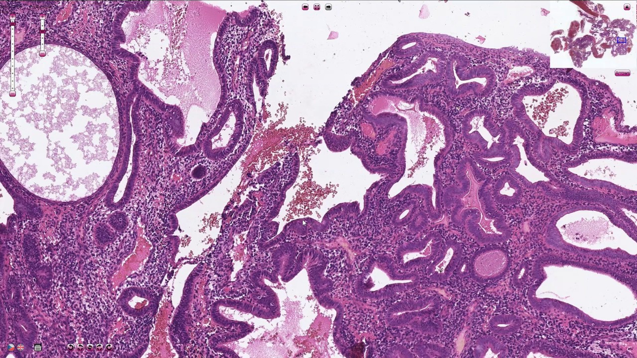 Endometrial Hyperplasia - Histopathology
