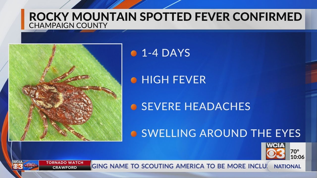 Rocky Mountain Spotted Fever confirmed in Champaign County
