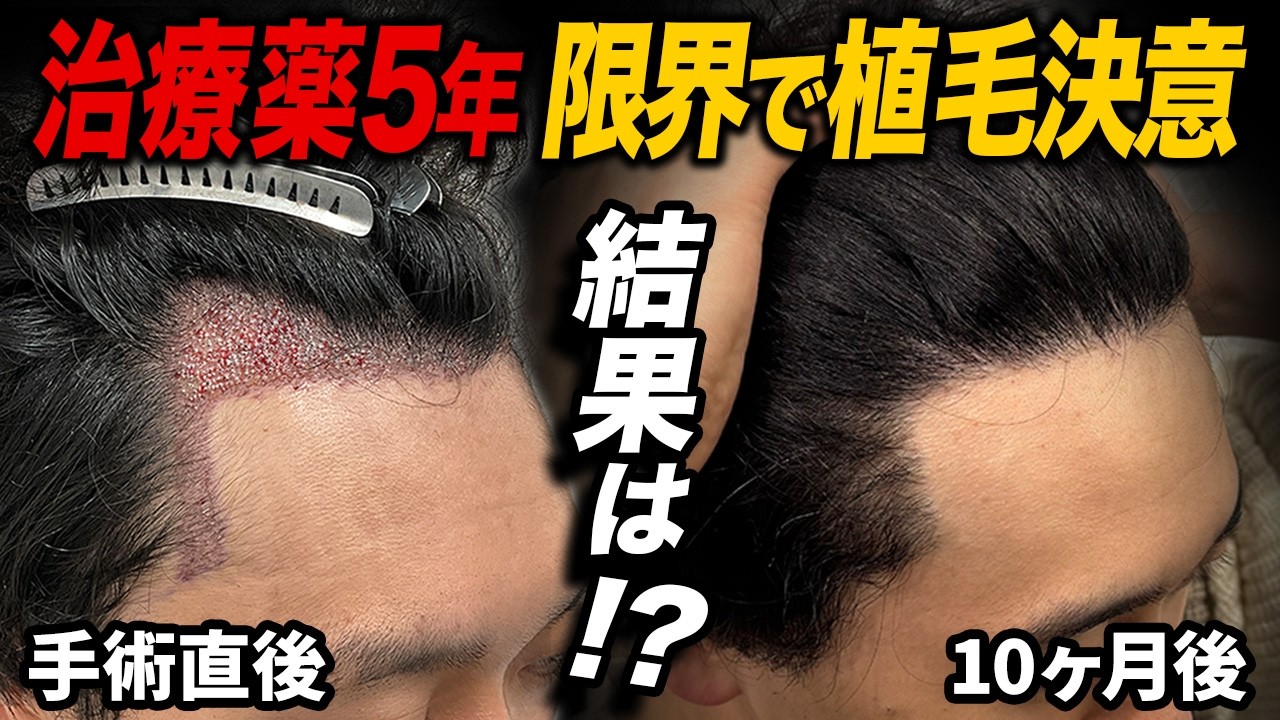 【植毛10ヶ月の結果】治療薬を5年以上飲んでも治らなかったM字