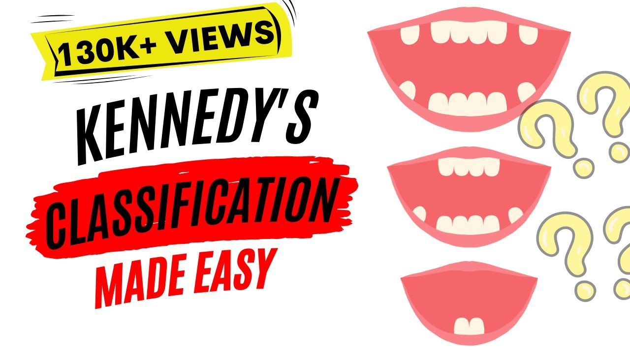 Kennedy's classification, Applegate's rules- Easy!