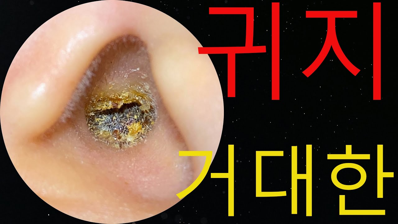 이비인후과 10살 귀지제거 내시경 영상 (ft. 함익병쇼) #earwax