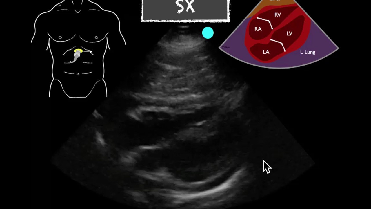 POCUS Teaching Point Pericardial effusion