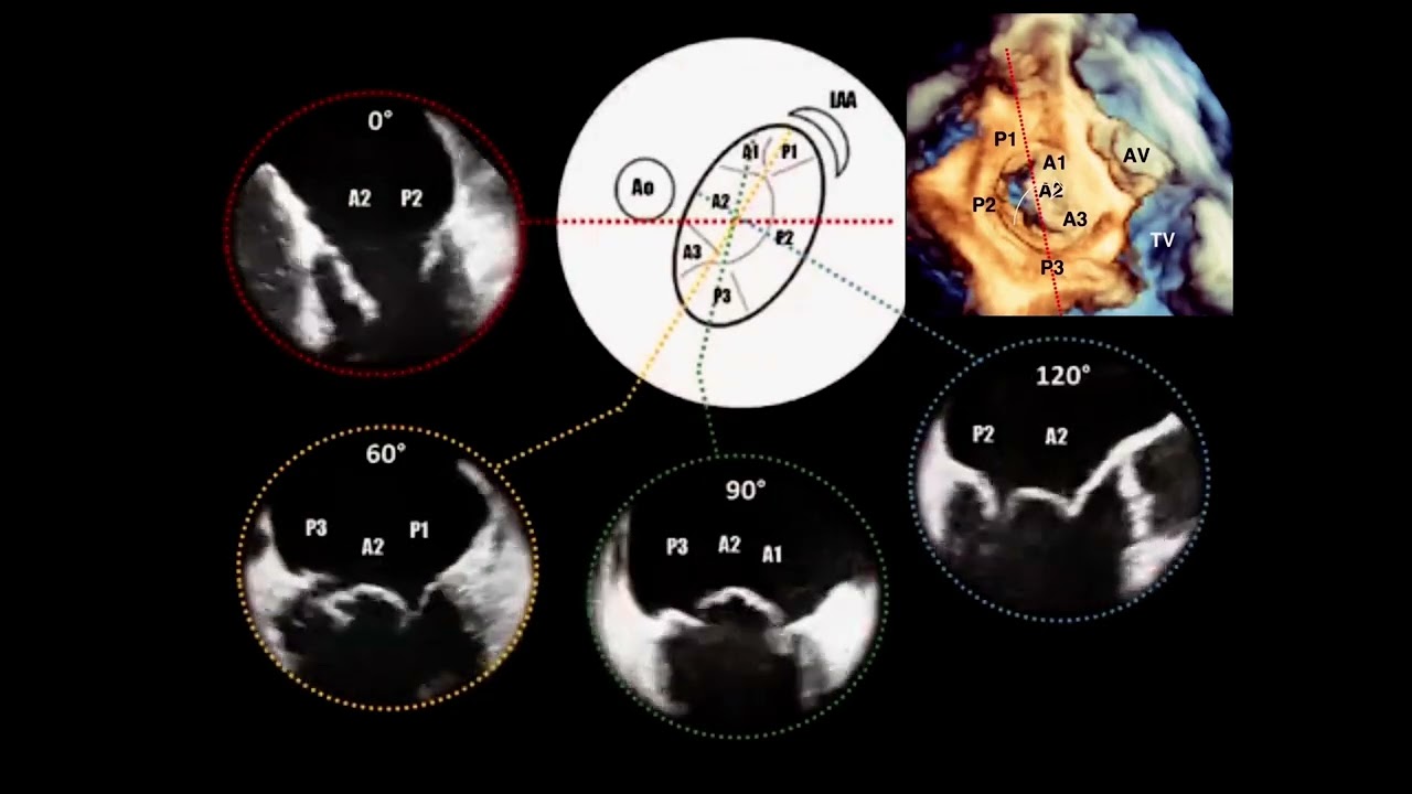 Segmentos de la V. Mitral