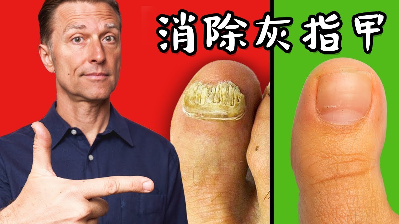 灰指甲真菌的消除方法,自然療法,柏格醫生 Dr Berg