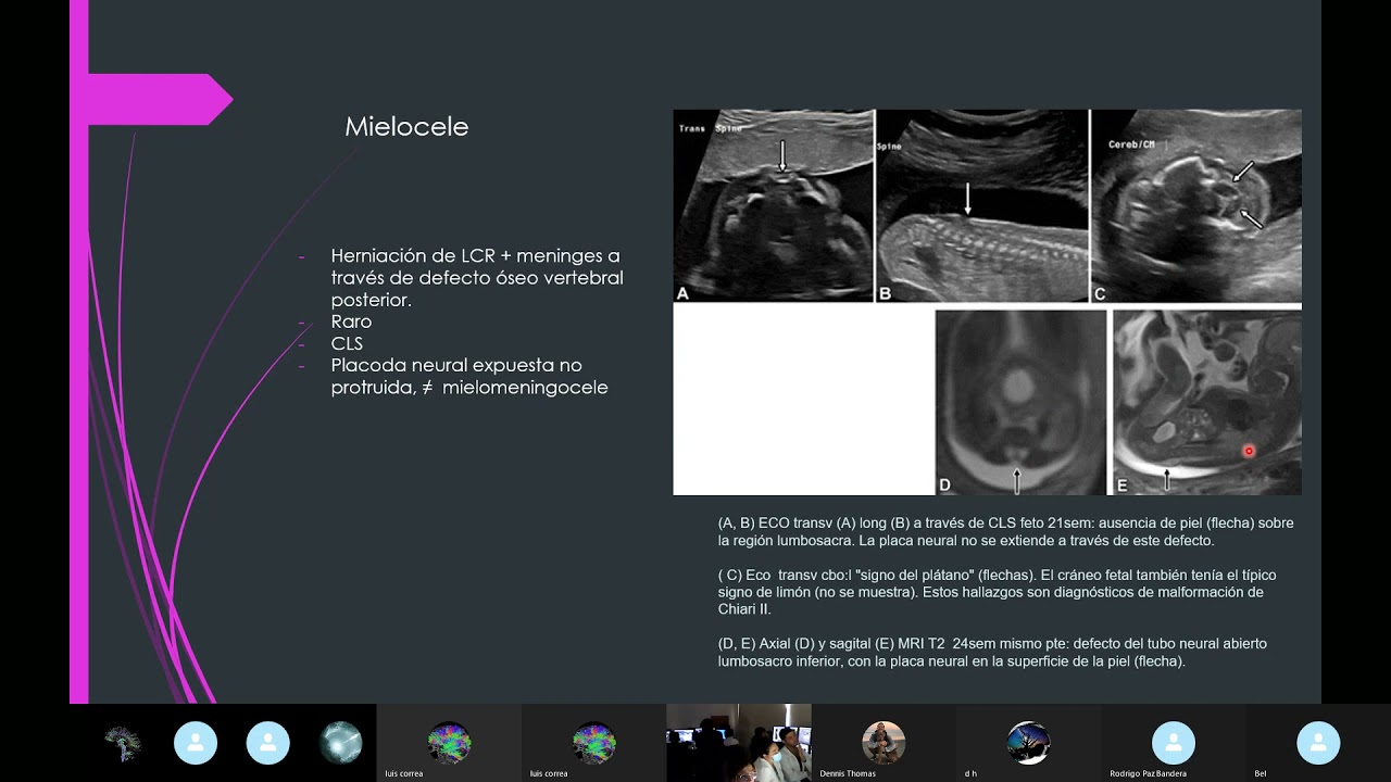 Columna Vertebral Fetal; Anomalías Congénitas