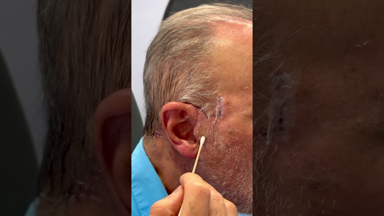 Facelift Techniques for Bearded Men Explained