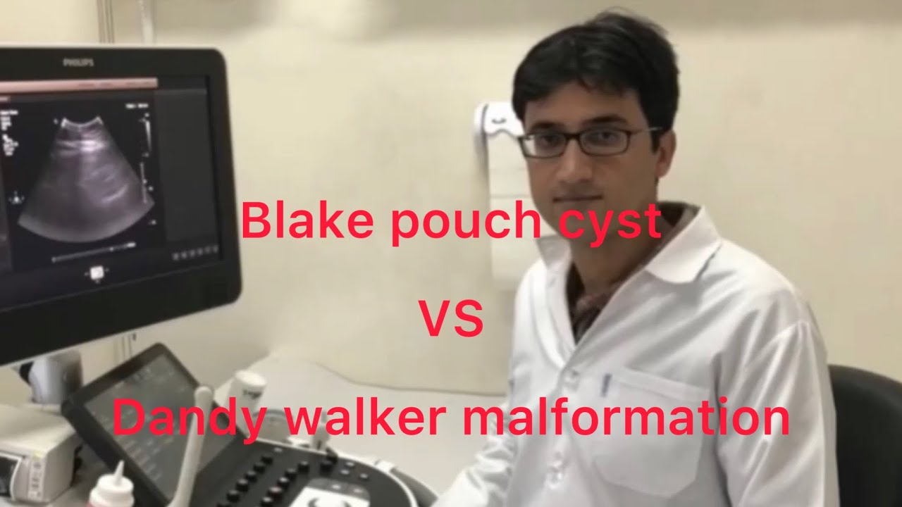 Sonography/ Blake’s pouch cyst and dandy walker malformation