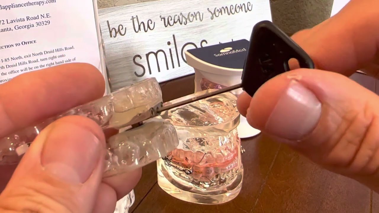 TAP device titration, advancement.  Oral appliance therapy for sleep apnea.