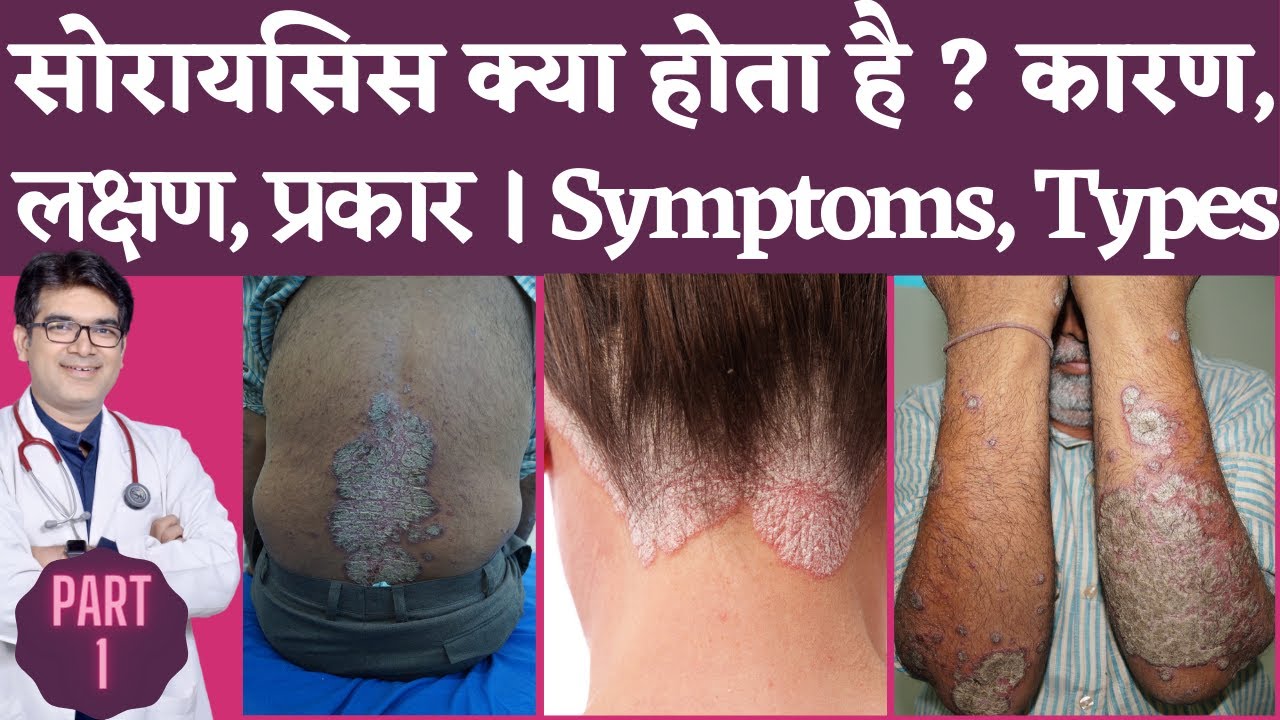 Psoriasis Causes, Symptoms, Types In Hindi | सोरायसिस क्या है, क्यूँ होता है, कारण, लक्षण, प्रकार