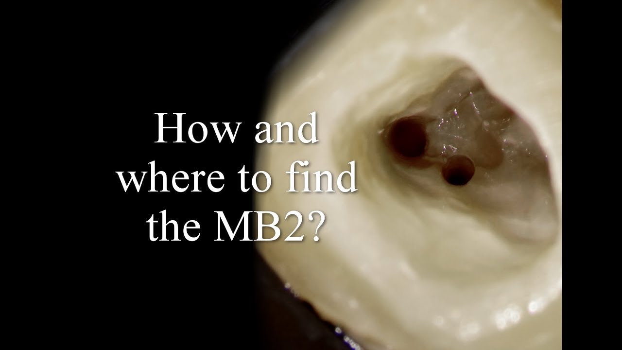 How and where to find the MB2 canals?