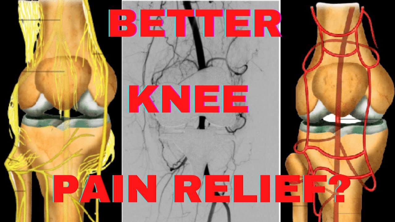 Knee pain: What exactly is Geniculate Artery Embolization and How it helps