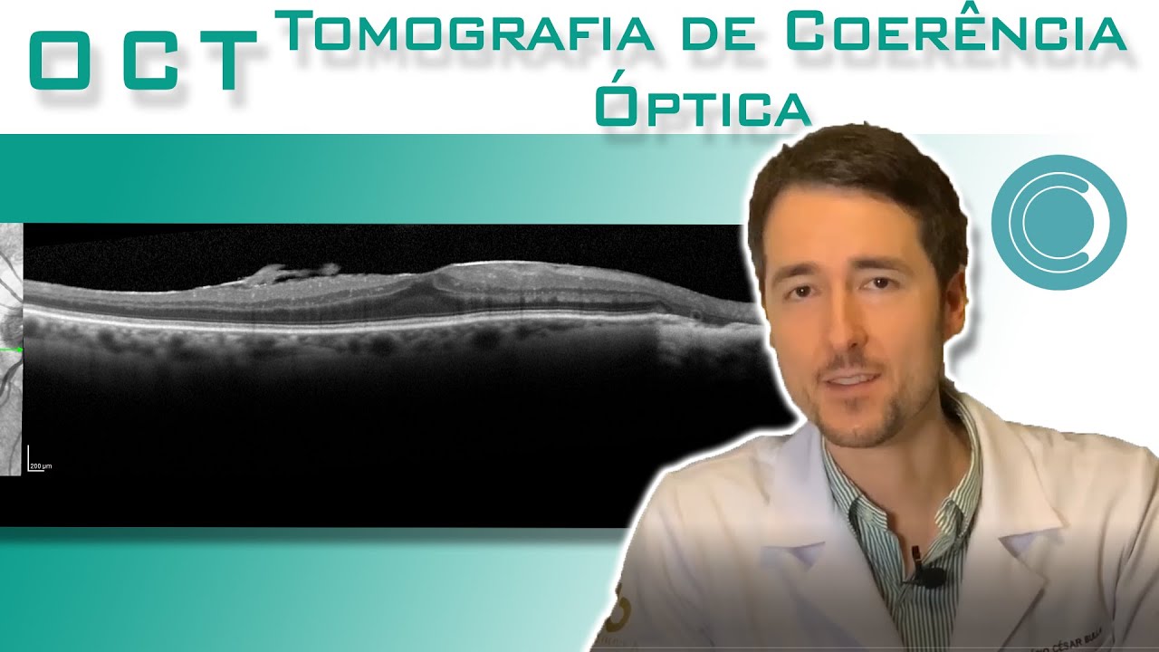 OCT -  Tomografia de Coer&ecirc;ncia &Oacute;ptica | Canal Retina e V&iacute;treo