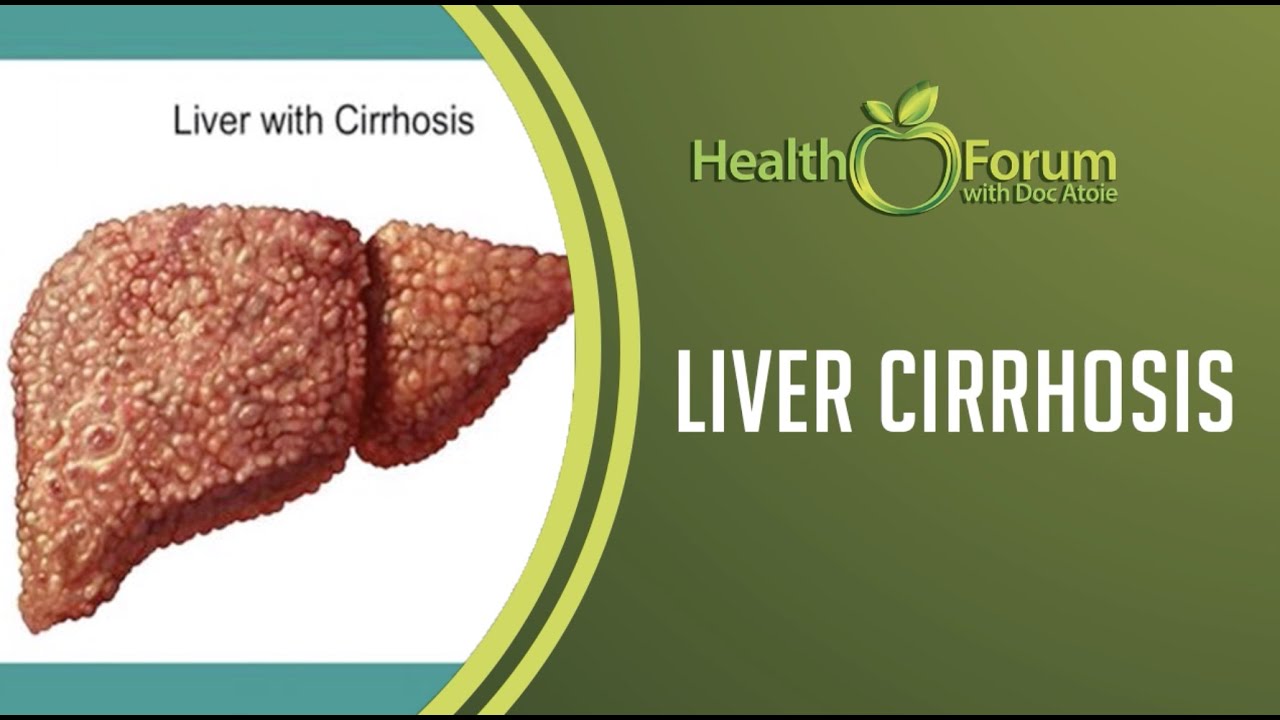 28 January 2020 | Word of the Day: Liver Cirrhosis