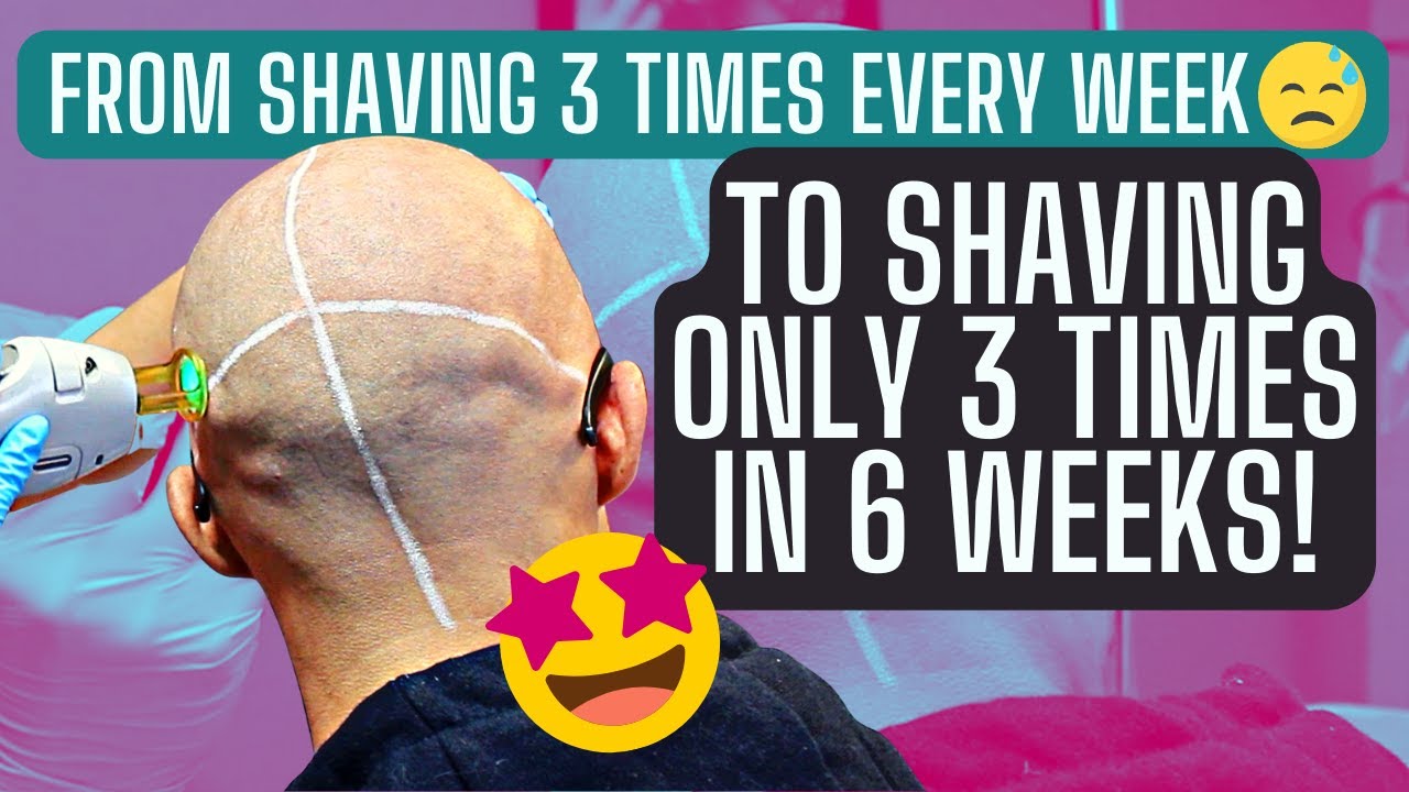 3RD SESSION OF LASER HAIR REMOVAL ON SCALP