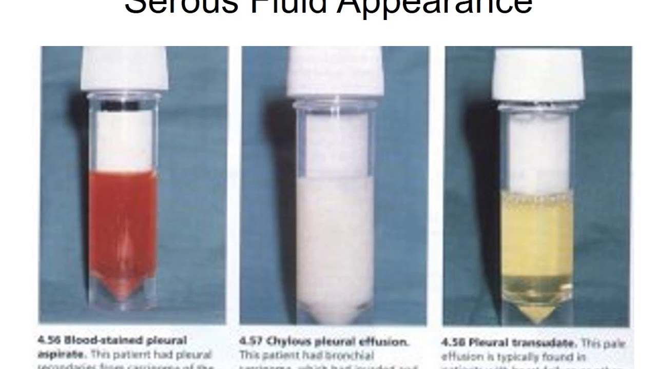Chapter 10   Serous Fluid analysis