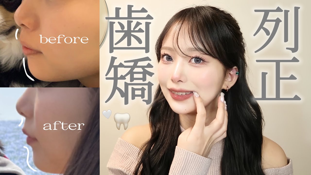 【歯列矯正】メリット・デメリットや総額費用💸経過など全て話します！