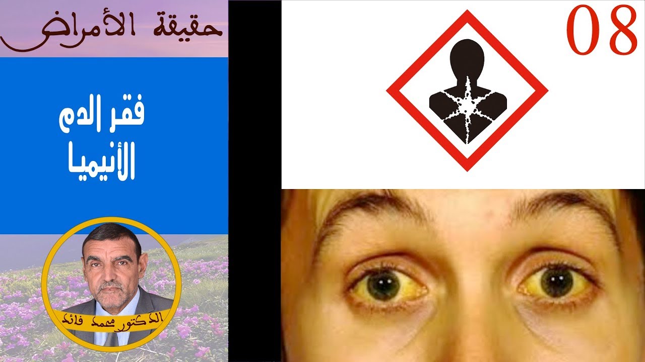 حقيقة فقر الدم  | الدكتور محمد فائد