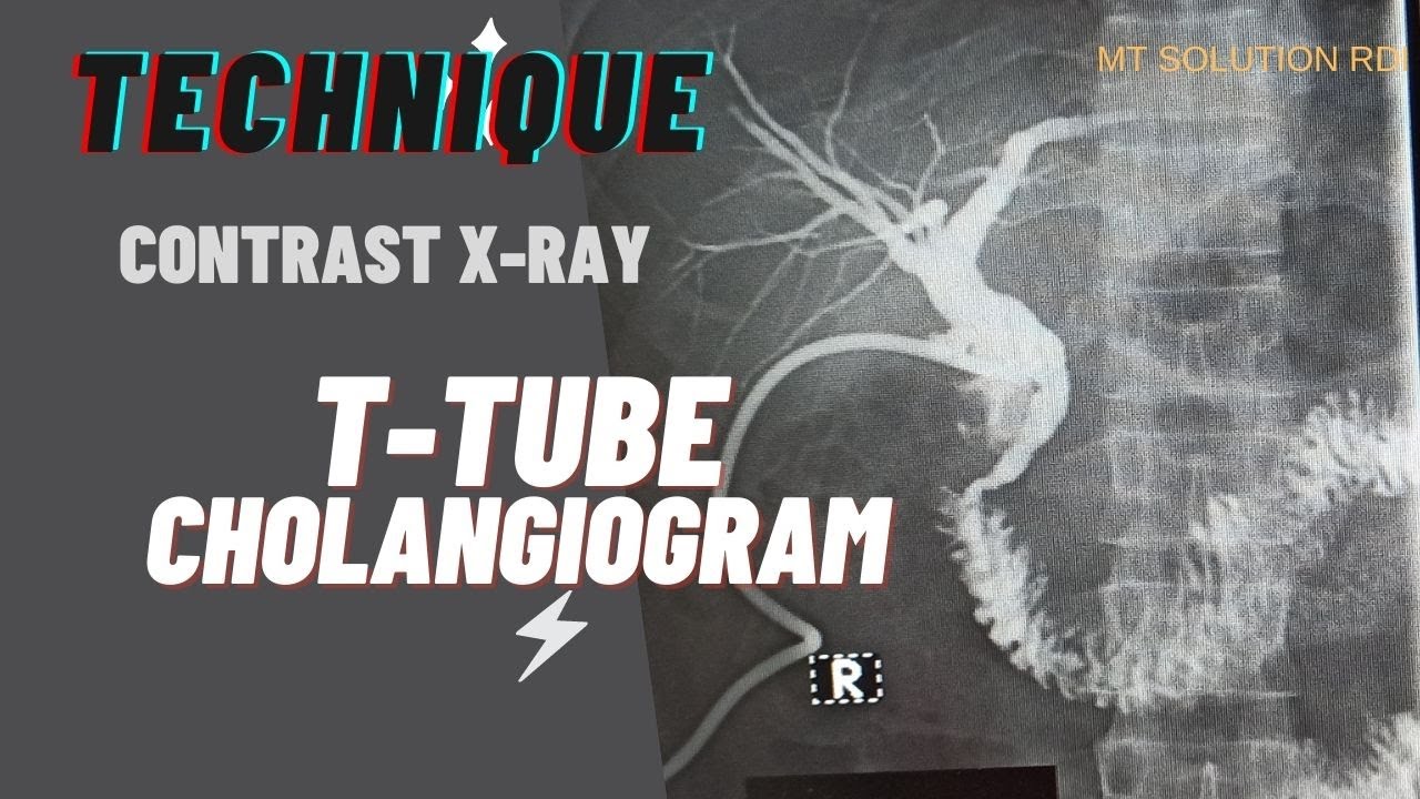 Technique of T-Tube Cholangiogram(Ep-44) |x-ray T-tube| contrast t-tube Cholangiogram