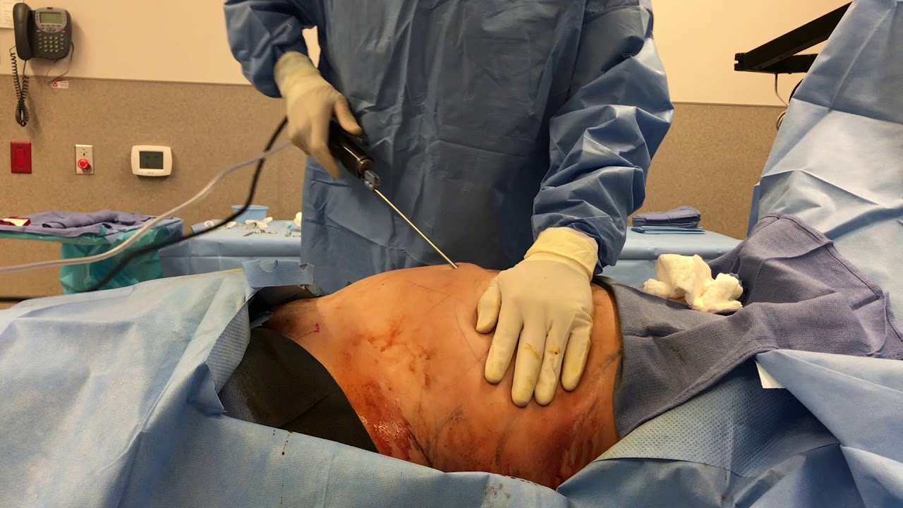 Liposuction of the Tummy! Orange County Plastic Surgery