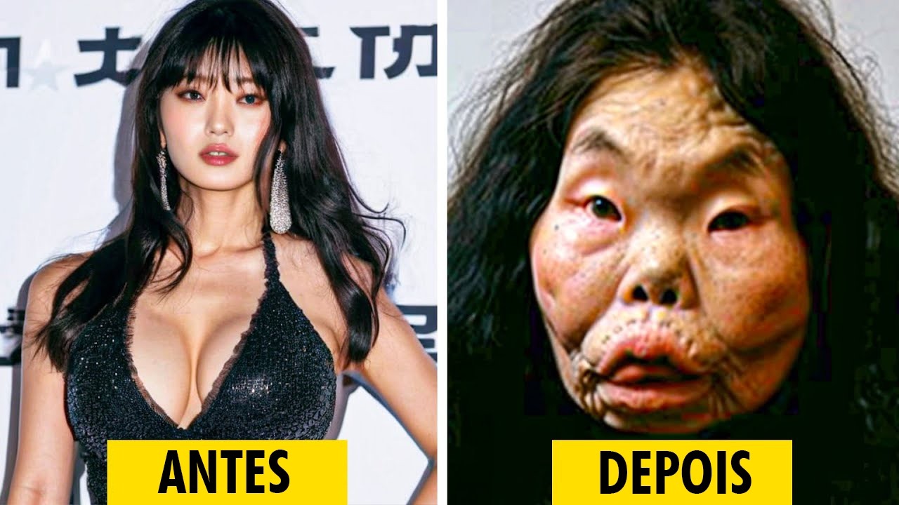 20 Desastres de Cirurgia Plástica de Celebridades