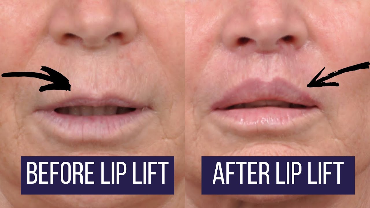 Los Angeles Upper Lip Lift | Beverly Hills Lip Augmentation Plastic Surgeon Dr. Ben Talei