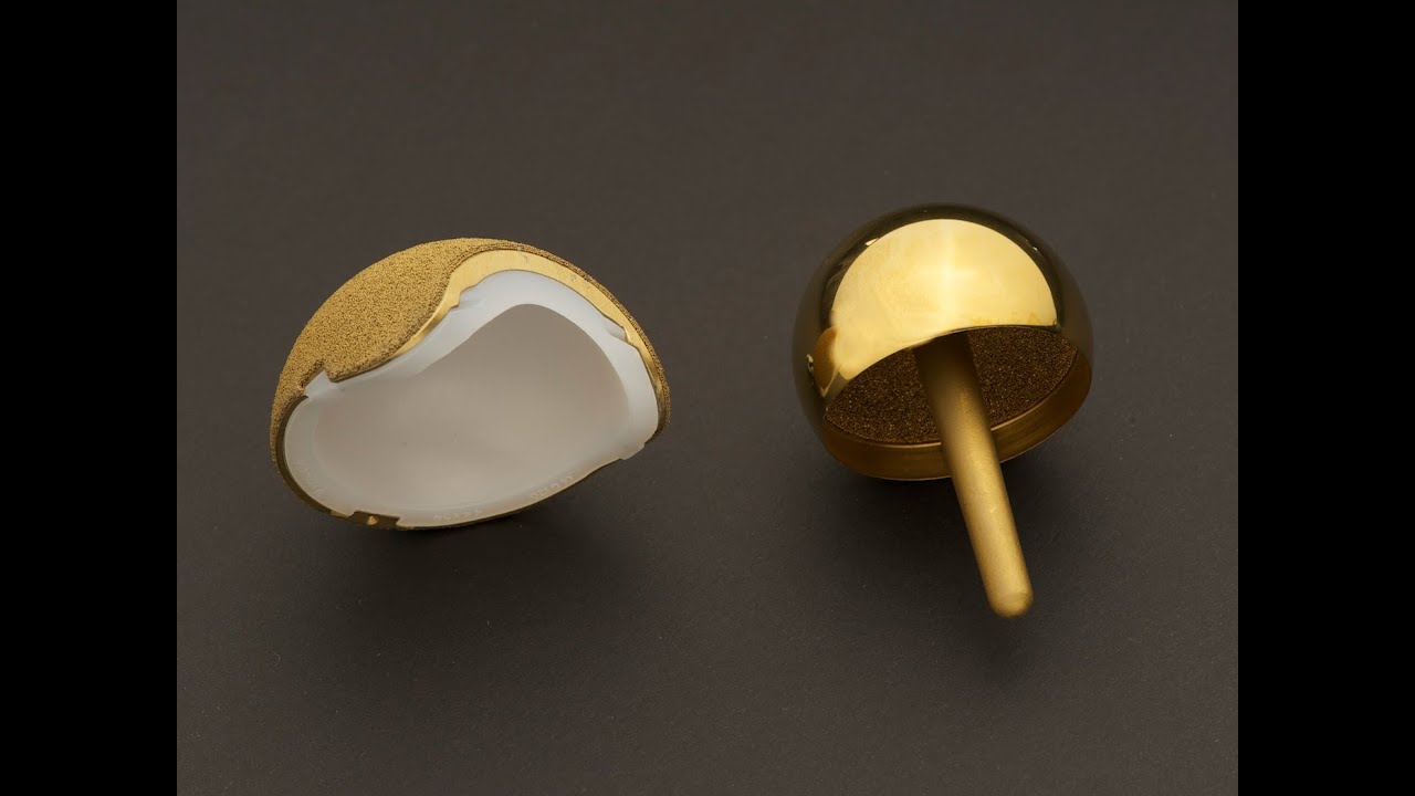 Surgeon Receives Polyethylene Hip Resurfacing