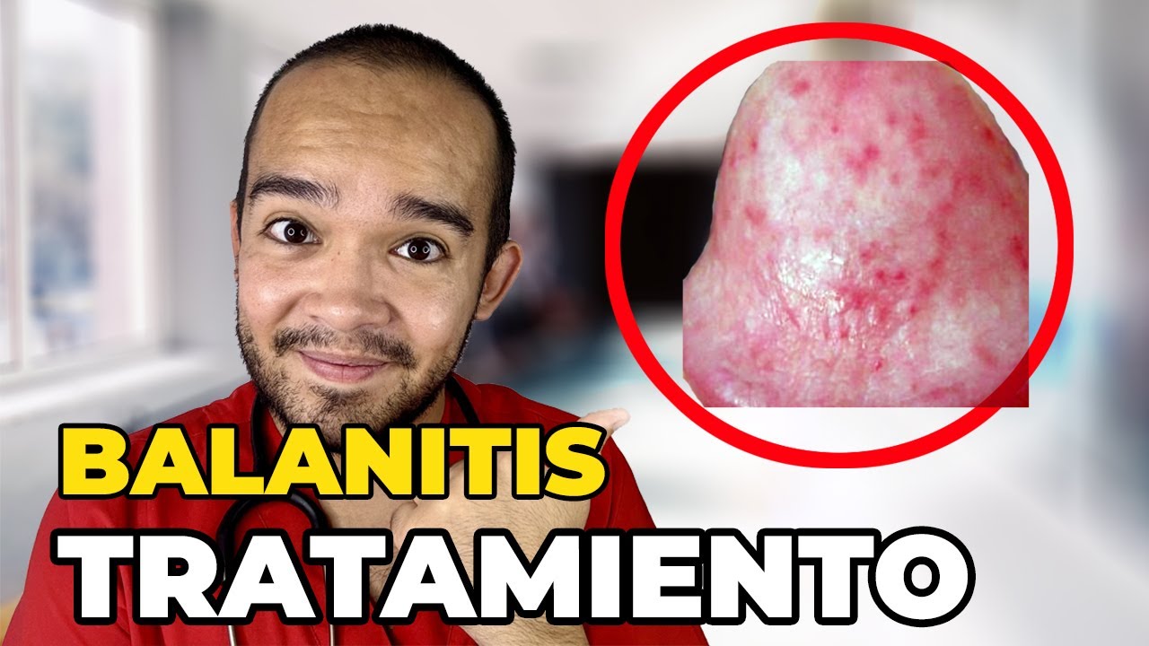 C&Oacute;MO CURAR LA BALANITIS