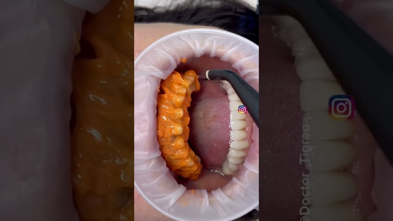 #dentist #dentistry #стоматология #стоматолог #виниры #odontologia #dental #bleach #braces #veneers