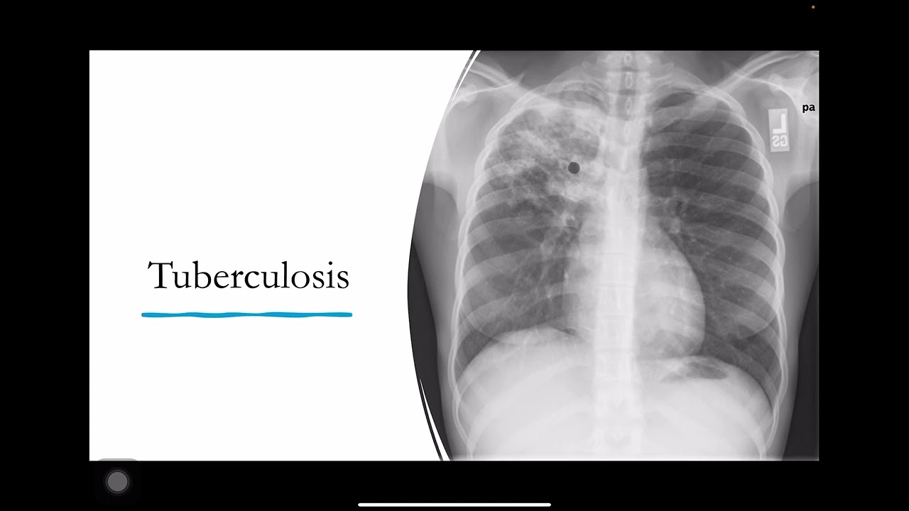 Chest X-rays: Never Miss These!